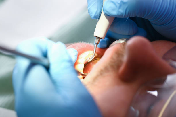 Best Emergency Wisdom Tooth Extraction in Macon, MS