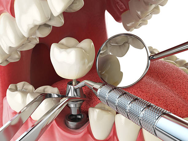 Best Lost Filling or Crown Replacement in Macon, MS